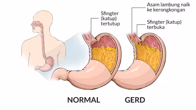 cara kerja obat maag